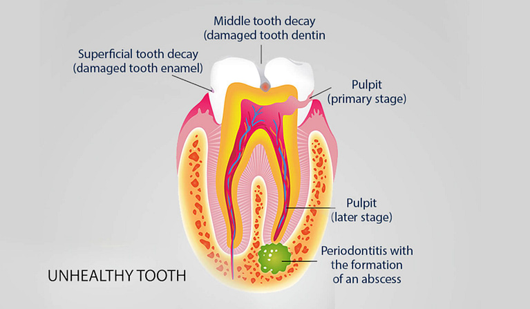 root canal therapy